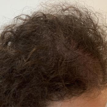 Après le traitement — cas 36