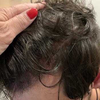 Après le traitement — cas 42