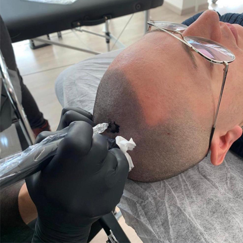 Traitement de tricopigmentation du cuir chevelu